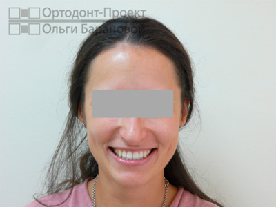 улыбка в результате нейромышечного и ортодонтического лечения
