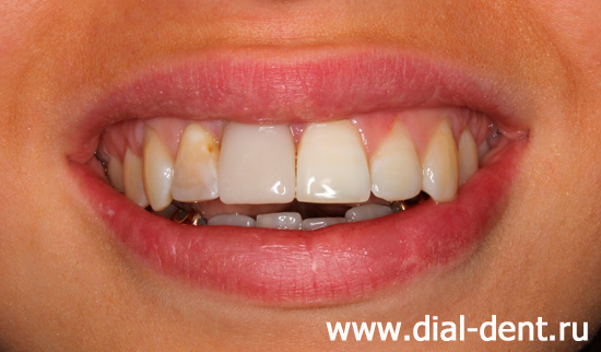 нарастили зуб светоотверждаемым композитом на период ортодонтического лечения