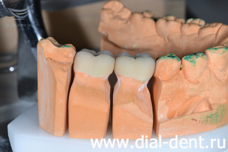 моделирование протезирования зубов в лаборатории "Диал-Дент"