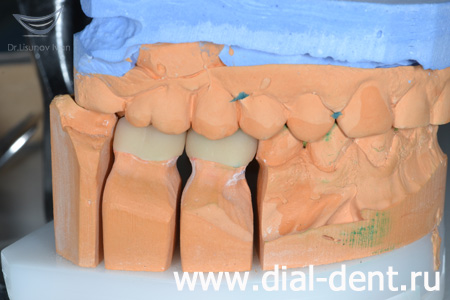 моделирование протезирования зубов в лаборатории "Диал-Дент"