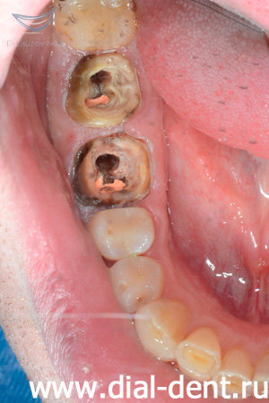 зубы после лечения каналов