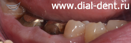 протезирование зубов золотом - культевые вкладки
