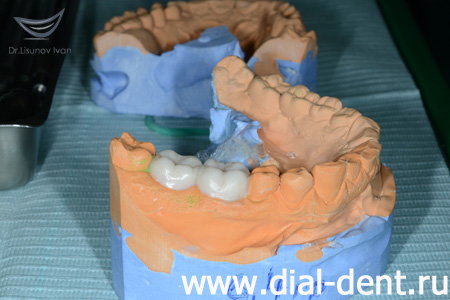 моделирование протезирования зубов