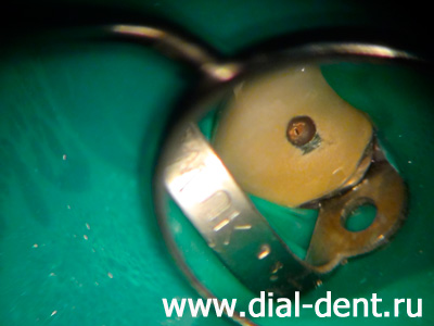 доступ к каналам зуба через металлокерамику
