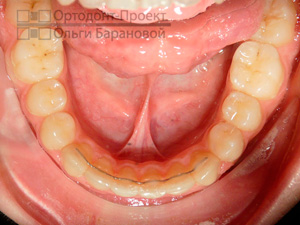после лечения у врача-ортодонта