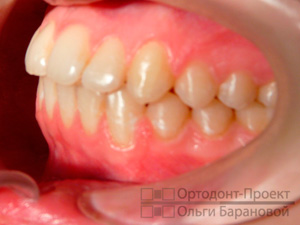после лечения у врача-ортодонта
