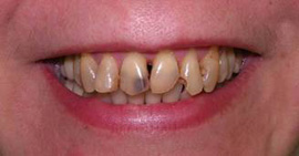 улыбка до лечения зубов