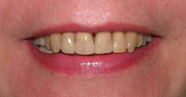 улыбка после лечения зубов