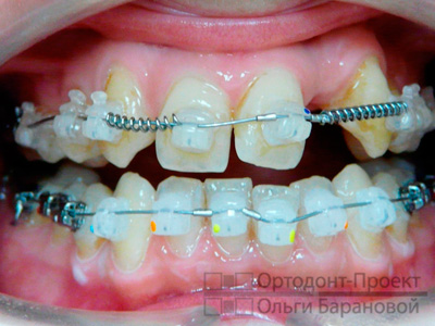 керамические брекеты на зубах