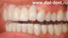 вид слева после протезирования зубов