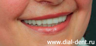 улыбка после сложного протезирования зубов в Диал-Дент