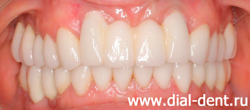результат протезирования зубов в Диал-Дент