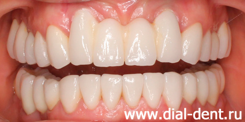 результат протезирования зубов в Диал-Дент