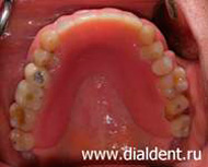 временное протезирование передних зубов