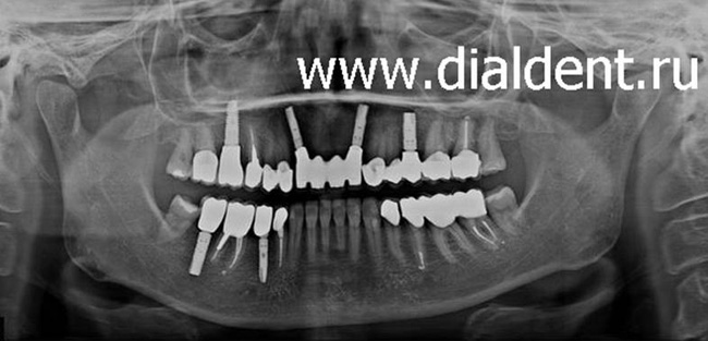 панорамный снимок зубов после лечения каналов и имплантации зубов в Диал-Дент