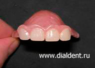 временное протезирование передних зубов