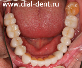 результат протезирования ни имплантах и керамические виниры на зубах нижней челюсти