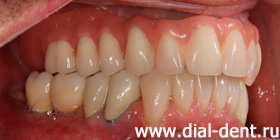 результат комплексного протезирования зубов в Диал-Дент - вид справа
