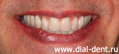 результат комплексного протезирования зубов в Диал-Дент