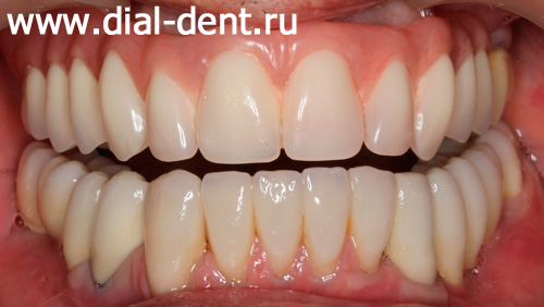 комплексное протезирование зубов в Диал-Дент
