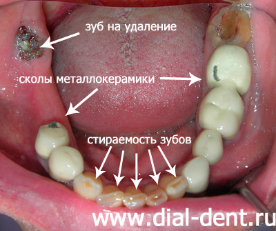 сколы металлокерамики, стертость зубов