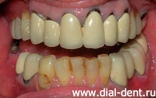 старые зубные протезы с множеством дефектов