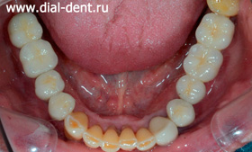 протезирование металлокерамикой - нижние зубы