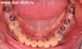 имплантация нижних зубов
