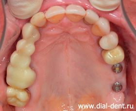 зубные импланты Альфа Био на верхней челюсти