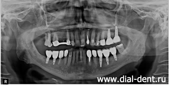 панорамный снимок зубов после имплантации