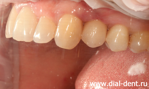 коронка из диоксида циркония на зубном импланте