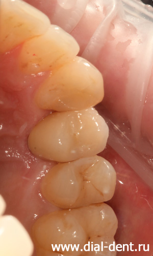 коронка из диоксида циркония на зубном импланте