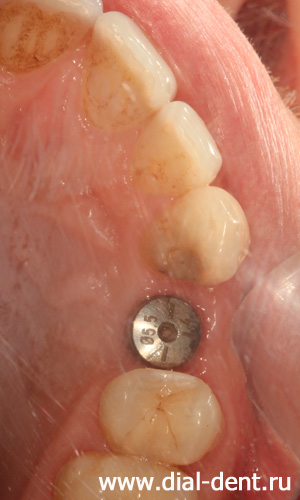 зубой имплант Astra Tech с формирователем десны