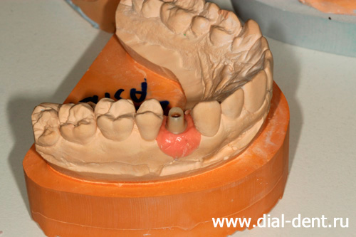 модель челюсти для изготовления индивидуального абатмента и зубной коронки