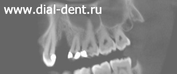 есть дефект костной ткани после удаления зуба