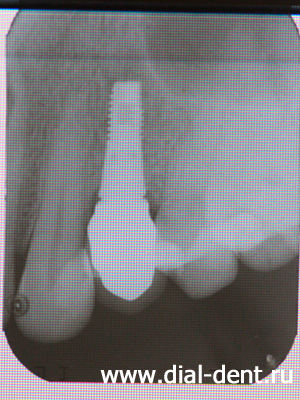 зубной имплант отлично сросся с костью челюсти