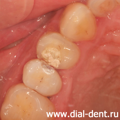 временные пломбы после лечения каналов зубов