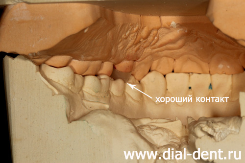 керамическая вкладка на модели - вид зубных контактов изнутри