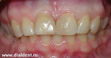 передние зубы после реставрации