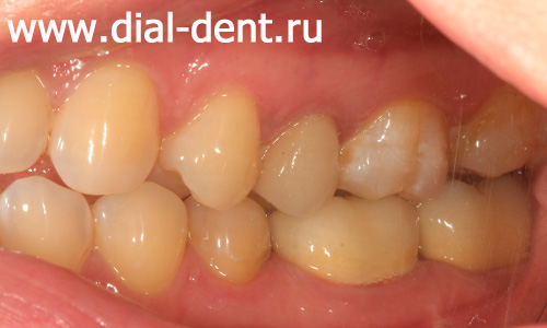 лечение каналов зубов и реставрация вкладками и коронками