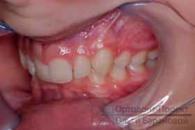 вид слева до ортодонтического лечения