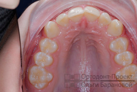 верхняя челюсть до ортодонтического лечения