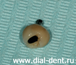зубная коронка, прикручиваемая на имплант