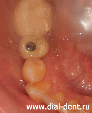 зубная коронка для протезирования на импланте
