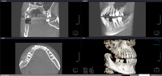 компьютерная томограмма зубов для расчета имплантации