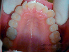 верхние зубы до лечения - криво растет второй резец, скученность зубов