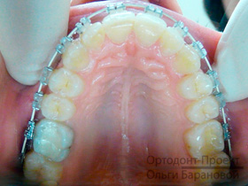 брекеты Clarity-SL - верхние зубы через 4,5 месяца