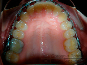верхние зубы через 10 месяцев лечения брекетами