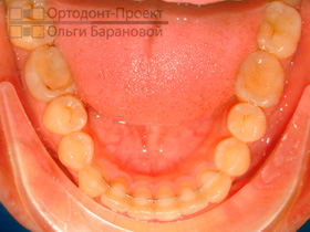 нижние зубы в результате комплексного ортодонтического лечения
