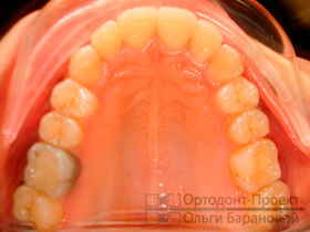 верхние зубы в результате комплексного ортодонтического лечения